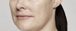 Restylane Lyft before and after