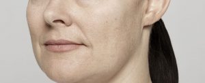 Restylane Lyft before and after