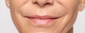 Restylane Silk before and after