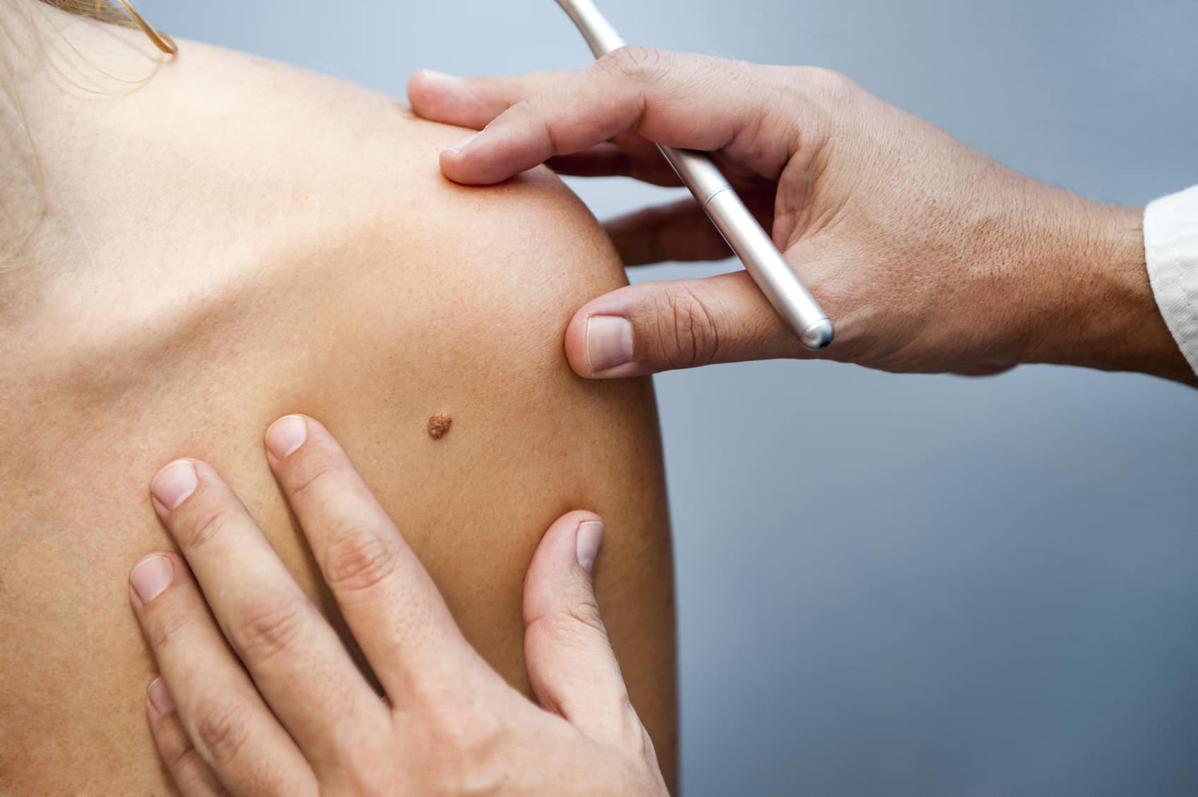 Mohs Surgery, Skin Cancer care in Rhode Island