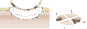 Mohs Micrographic Surgery technique