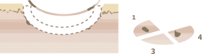 Mohs Micrographic Surgery technique