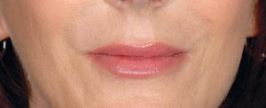 Restylane before and after