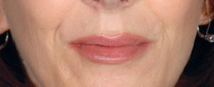 Restylane before and after