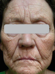 Lumenis Ultrapulse Encore before and after
