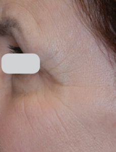 Lumenis Ultrapulse Encore before and after