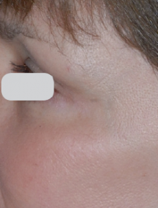 Lumenis Ultrapulse Encore before and after