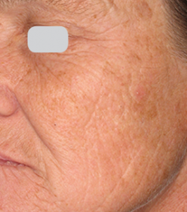 Lumenis Ultrapulse Encore before and after