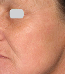 Lumenis Ultrapulse Encore before and after
