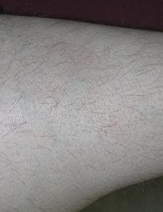 XTRAC psoriasis after