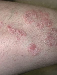 XTRAC psoriasis before