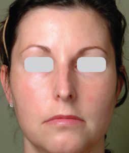 ResurFX before & after