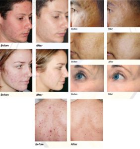SmoothBeam Laser before and after